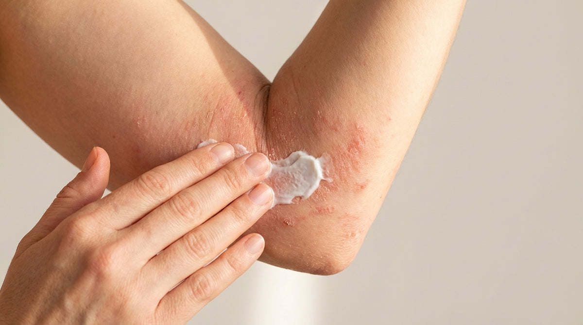 Is Tallow Good for Eczema? What the Fatty Acid Research Actually Shows